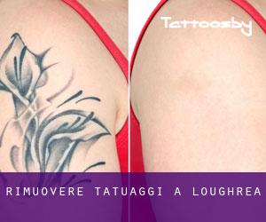 Rimuovere Tatuaggi a Loughrea