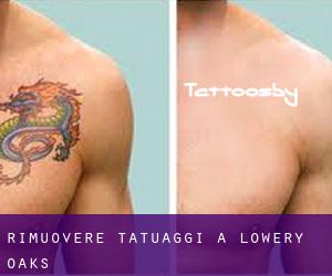 Rimuovere Tatuaggi a Lowery Oaks