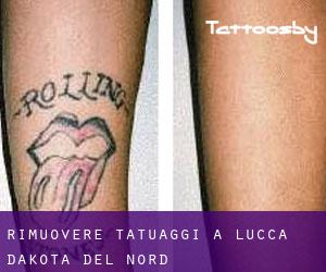 Rimuovere Tatuaggi a Lucca (Dakota del Nord)