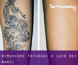 Rimuovere Tatuaggi a Luco dei Marsi