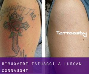 Rimuovere Tatuaggi a Lurgan (Connaught)