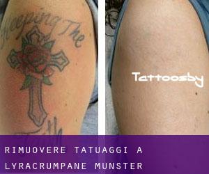 Rimuovere Tatuaggi a Lyracrumpane (Munster)