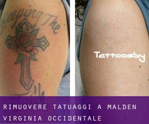 Rimuovere Tatuaggi a Malden (Virginia Occidentale)