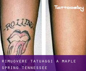 Rimuovere Tatuaggi a Maple Spring (Tennessee)