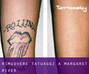 Rimuovere Tatuaggi a Margaret River