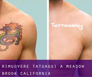 Rimuovere Tatuaggi a Meadow Brook (California)