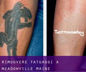 Rimuovere Tatuaggi a Meadowville (Maine)