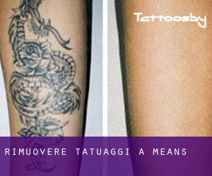 Rimuovere Tatuaggi a Means