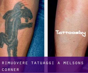 Rimuovere Tatuaggi a Melsons Corner