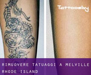 Rimuovere Tatuaggi a Melville (Rhode Island)