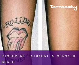 Rimuovere Tatuaggi a Mermaid Beach