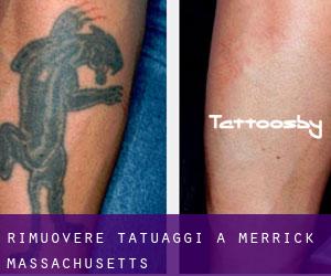 Rimuovere Tatuaggi a Merrick (Massachusetts)