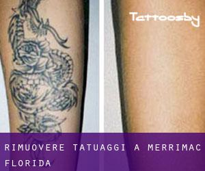 Rimuovere Tatuaggi a Merrimac (Florida)