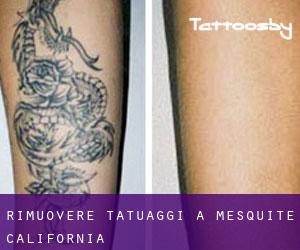 Rimuovere Tatuaggi a Mesquite (California)