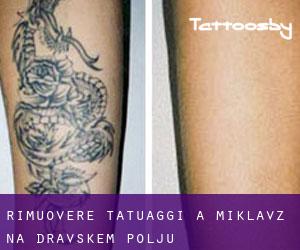 Rimuovere Tatuaggi a Miklavž na Dravskem Polju