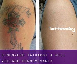 Rimuovere Tatuaggi a Mill Village (Pennsylvania)