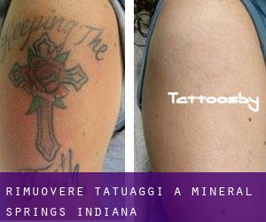 Rimuovere Tatuaggi a Mineral Springs (Indiana)