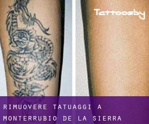 Rimuovere Tatuaggi a Monterrubio de la Sierra