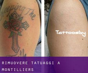 Rimuovere Tatuaggi a Montilliers