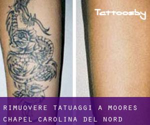 Rimuovere Tatuaggi a Moores Chapel (Carolina del Nord)