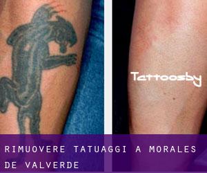 Rimuovere Tatuaggi a Morales de Valverde
