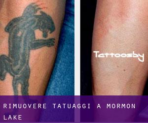 Rimuovere Tatuaggi a Mormon Lake