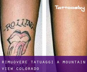 Rimuovere Tatuaggi a Mountain View (Colorado)