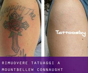 Rimuovere Tatuaggi a Mountbellew (Connaught)