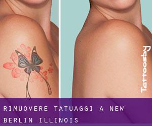 Rimuovere Tatuaggi a New Berlin (Illinois)