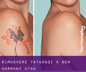 Rimuovere Tatuaggi a New Harmony (Utah)