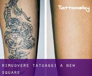 Rimuovere Tatuaggi a New Square