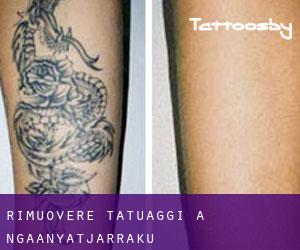Rimuovere Tatuaggi a Ngaanyatjarraku