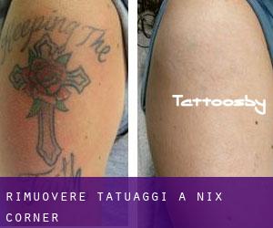 Rimuovere Tatuaggi a Nix Corner