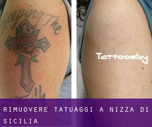 Rimuovere Tatuaggi a Nizza di Sicilia