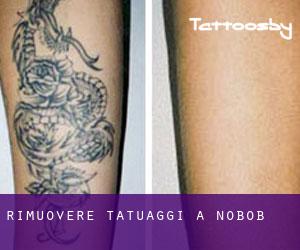 Rimuovere Tatuaggi a Nobob