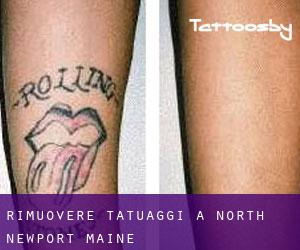 Rimuovere Tatuaggi a North Newport (Maine)