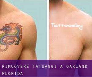 Rimuovere Tatuaggi a Oakland (Florida)