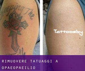 Rimuovere Tatuaggi a Opaeopaeilio