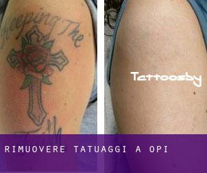 Rimuovere Tatuaggi a Opi