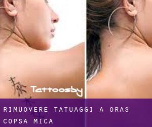 Rimuovere Tatuaggi a Oraş Copşa Micã