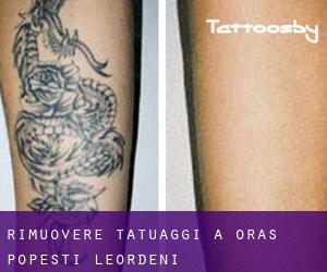 Rimuovere Tatuaggi a Oraş Popeşti Leordeni