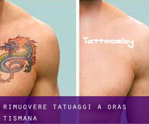 Rimuovere Tatuaggi a Oraş Tismana