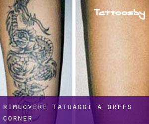 Rimuovere Tatuaggi a Orffs Corner
