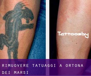 Rimuovere Tatuaggi a Ortona dei Marsi