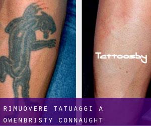 Rimuovere Tatuaggi a Owenbristy (Connaught)