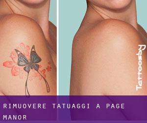 Rimuovere Tatuaggi a Page Manor