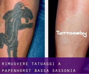 Rimuovere Tatuaggi a Papenhorst (Bassa Sassonia)