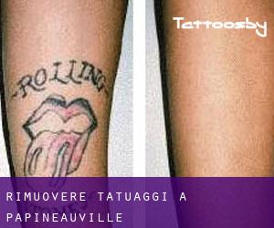 Rimuovere Tatuaggi a Papineauville