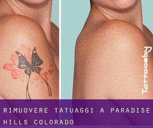 Rimuovere Tatuaggi a Paradise Hills (Colorado)