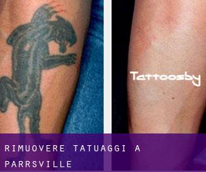 Rimuovere Tatuaggi a Parrsville